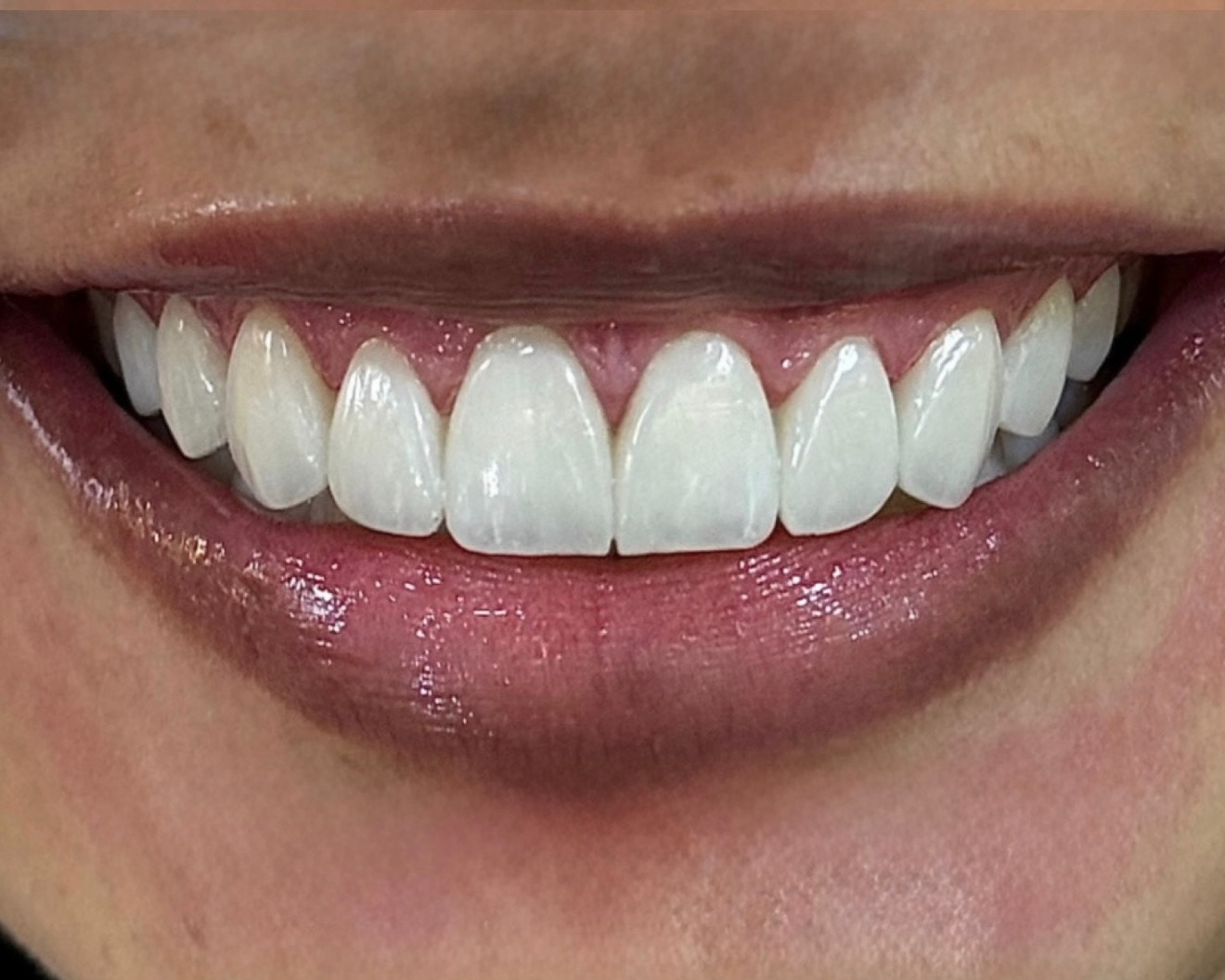 Resultado de lentes de contato dental - Sorriso feminino natural