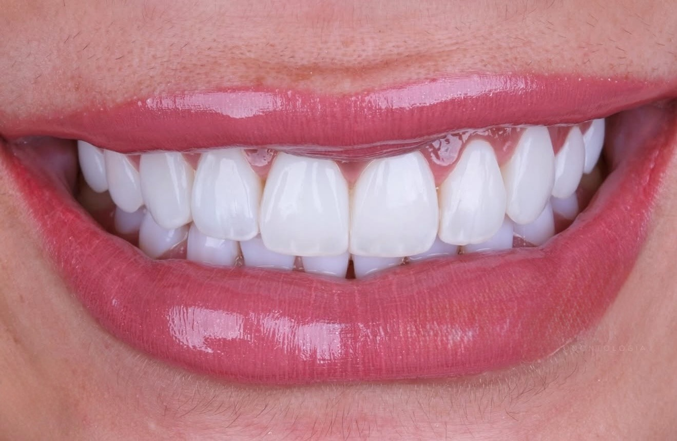 Resultado de lentes de contato dental - Sorriso feminino harmonioso