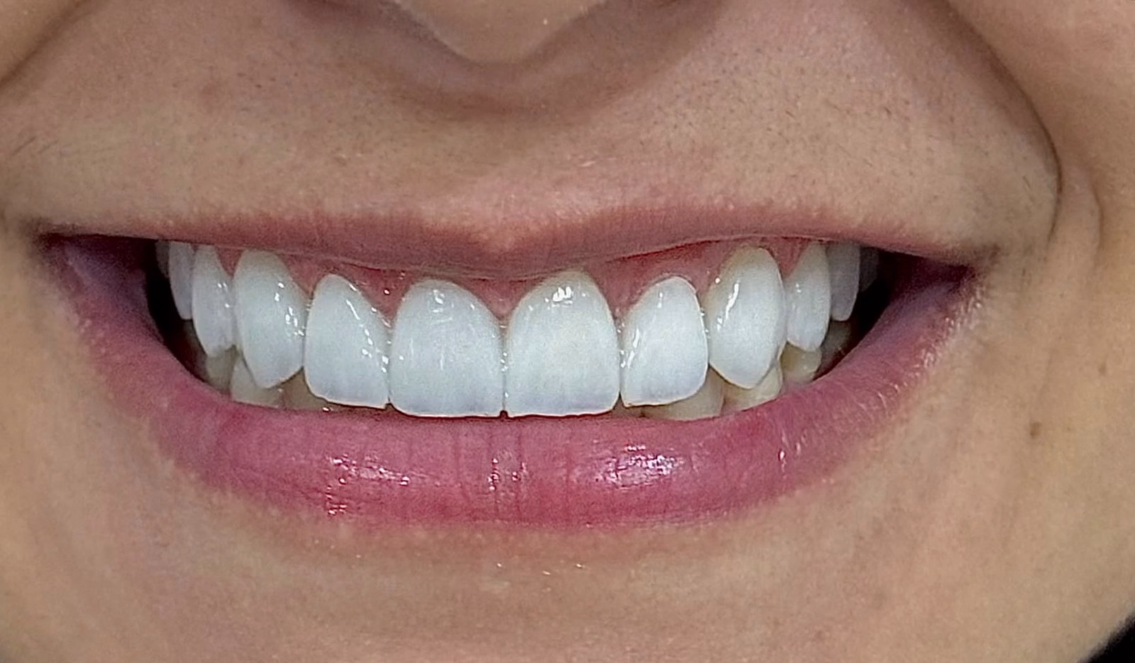 Resultado de lentes de contato dental - Sorriso feminino elegante