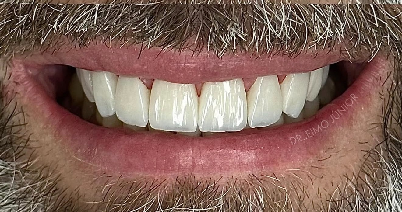 Resultado de lentes de contato dental - Sorriso masculino natural