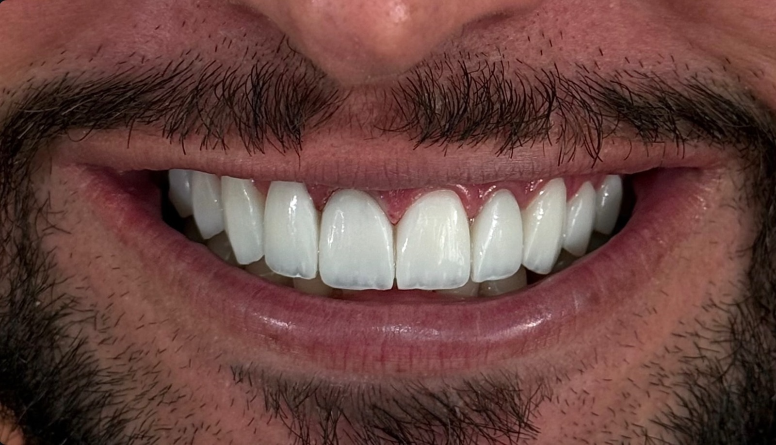 Resultado de lentes de contato dental - Sorriso masculino impactante